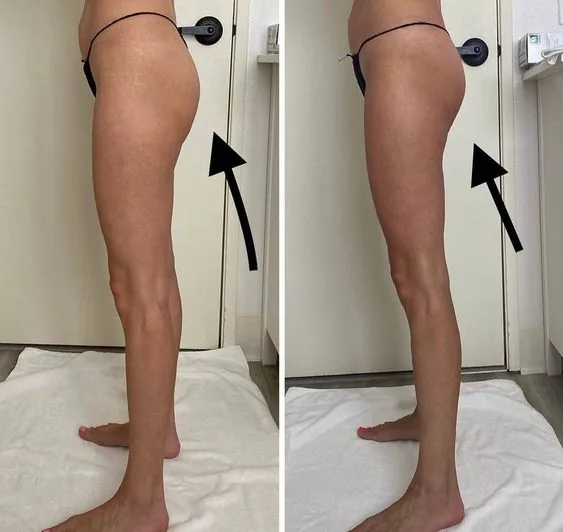 Endosphères before and after body contouring result example